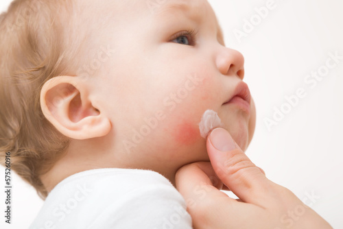 Young adult mother finger applying white medical ointment on infant boy cheek on light gray background. Red rash on skin. Allergy from food, milk formula or mother milk. Care about baby body. Closeup.