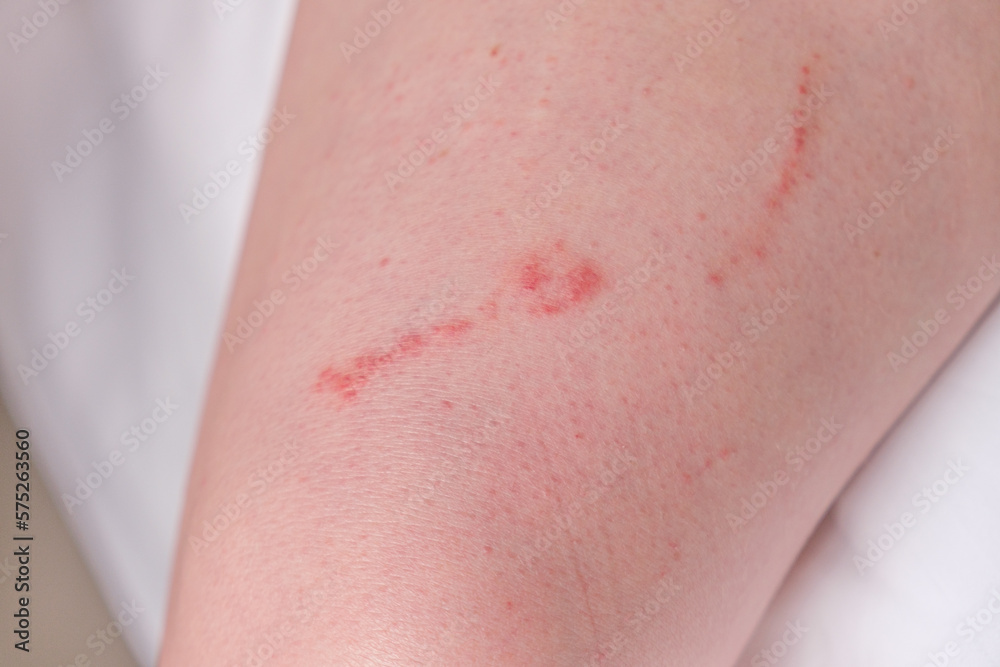 An allergic reaction on the skin from contact with a jellyfish An allergic reaction on the skin from contact with a jellyfish