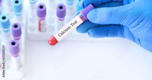 Doctor holding a test blood sample tube with calcium test on the background of medical test tubes with analyzes.Copy space for text