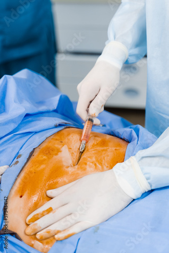 Close-up liposuction of abdomen. Surgeon does abdominoplasty for woman. Plastical operation in medical clinic. photo