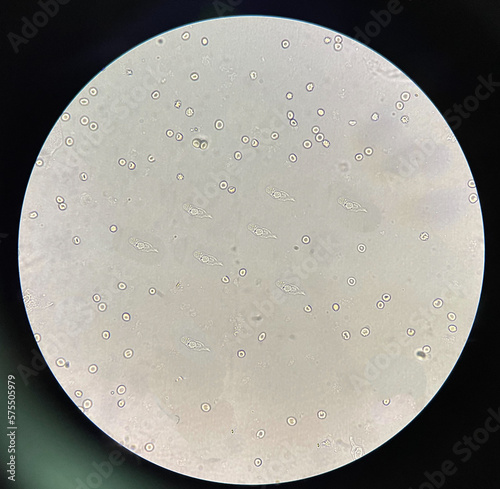 renal epithelial cell with rbc in Urine