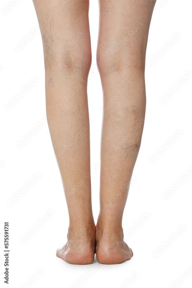 Closeup view of woman with varicose veins on white background Closeup view of woman with varicose veins on white background