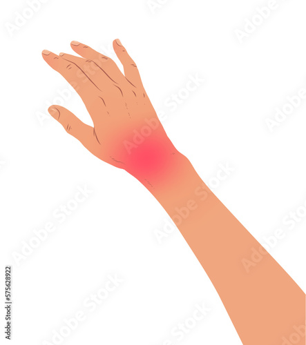 Vector illustration of hand with carpal tunnel syndrome