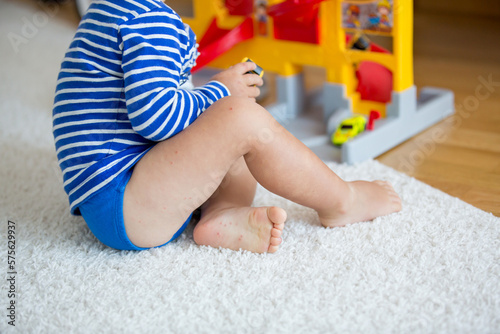 Hand foot and mouth disease in child photo