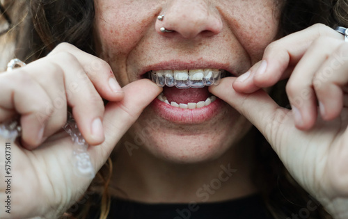 unrecognizable woman putting on an invisible tooth apparatus. aesthetic orthodontics photo