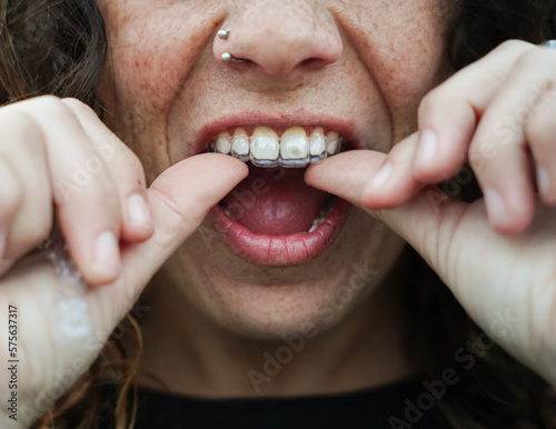 unrecognizable woman putting an invisible teeth brace in her mouth. Dental prosthesis