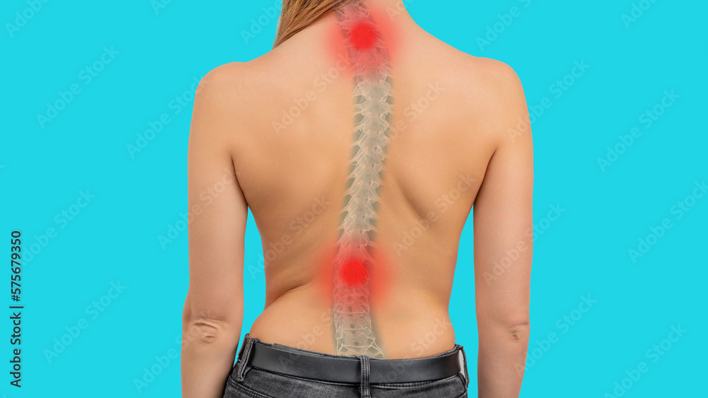 Woman with scoliosis of the spine. Curved woman's back. Severe pain in the cervical and lower thoracic or lumbar spine - obrazy, fototapety, plakaty 