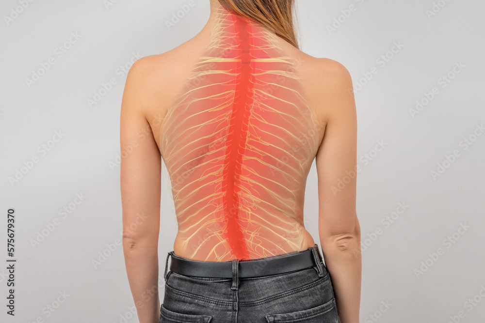 Foto de Woman with scoliosis of the spine. Curved woman's back
