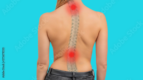 Woman with scoliosis of the spine. Curved woman's back. Severe pain in the cervical and lower thoracic or lumbar spine photo