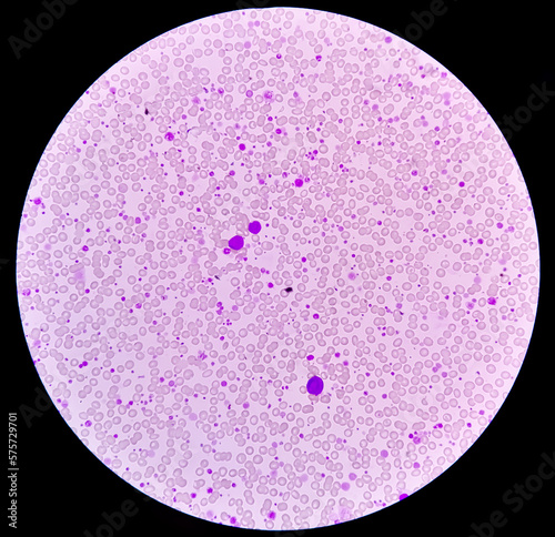 Chronic myeloid leukemia (CML) in accelerated phase with thrombocytosis. Chronic myelogenous leukemia. photo