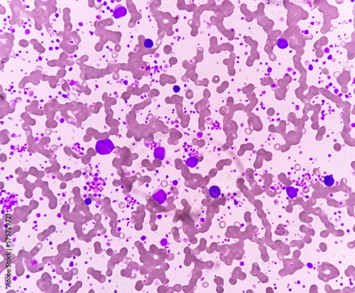 Chronic myeloid leukemia (CML) in accelerated phase with thrombocytosis. Chronic myelogenous leukemia. photo