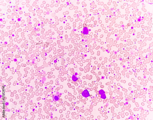 Chronic myeloid leukemia (CML) in accelerated phase with thrombocytosis. Chronic myelogenous leukemia. photo