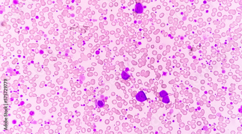Chronic myeloid leukemia (CML) in accelerated phase with thrombocytosis. Chronic myelogenous leukemia. photo