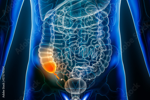 Appendicitis disease or vermiform appendix inflammation 3D rendering illustration front or anterior view. Anatomy, surgery, biomedical, disease, medical, biology, science, healthcare concepts. photo