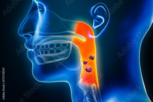 Pharyngeal or throat cancer with organs and tumors or cancerous cells 3D rendering illustration. Anatomy, oncology, pharynx disease, medical, biology, science, healthcare concepts.
