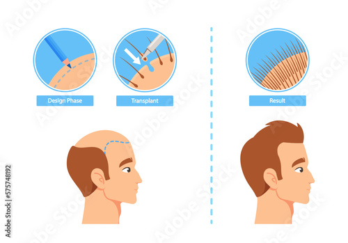 Hair Transplantation Process Infographics Including Design Phase, Transplant and Result Stages. Before and After Images