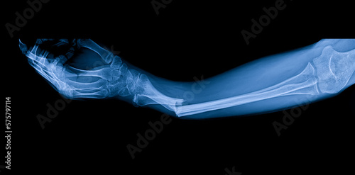 Canvas Print Blue tone radiograph on dark background in hospital