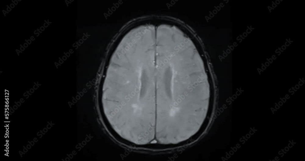MRI Brain can help doctors look for conditions such as bleeding, swelling, tumors, infections