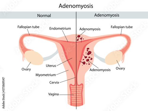 Anatomical illustration of the normal female reproductive system and with the symptoms of adenomyosis, with annotations.