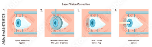 LASIK eye surgery. Patient receiving optical correction with a laser.