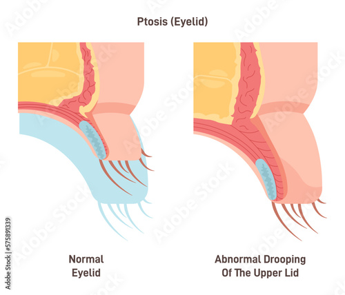 Ptosis. Drooping of the upper eyelid. Lazy eye caused by weakened