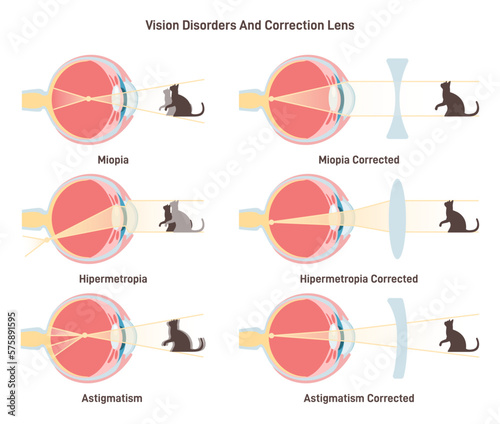Myopia, hyperopia and astigmatism. Common vision disorders and its correction photo