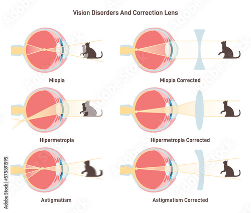 Myopia, hyperopia and astigmatism. Common vision disorders and its correction