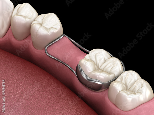 Fototapeta Naklejka Na Ścianę i Meble -  Space Maintainer Unilateral keeps from teeth shift deformatiuon after losing molar tooth. 3D illustration