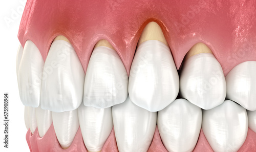 Gingiva recession. 3D illustration of Dental problem photo