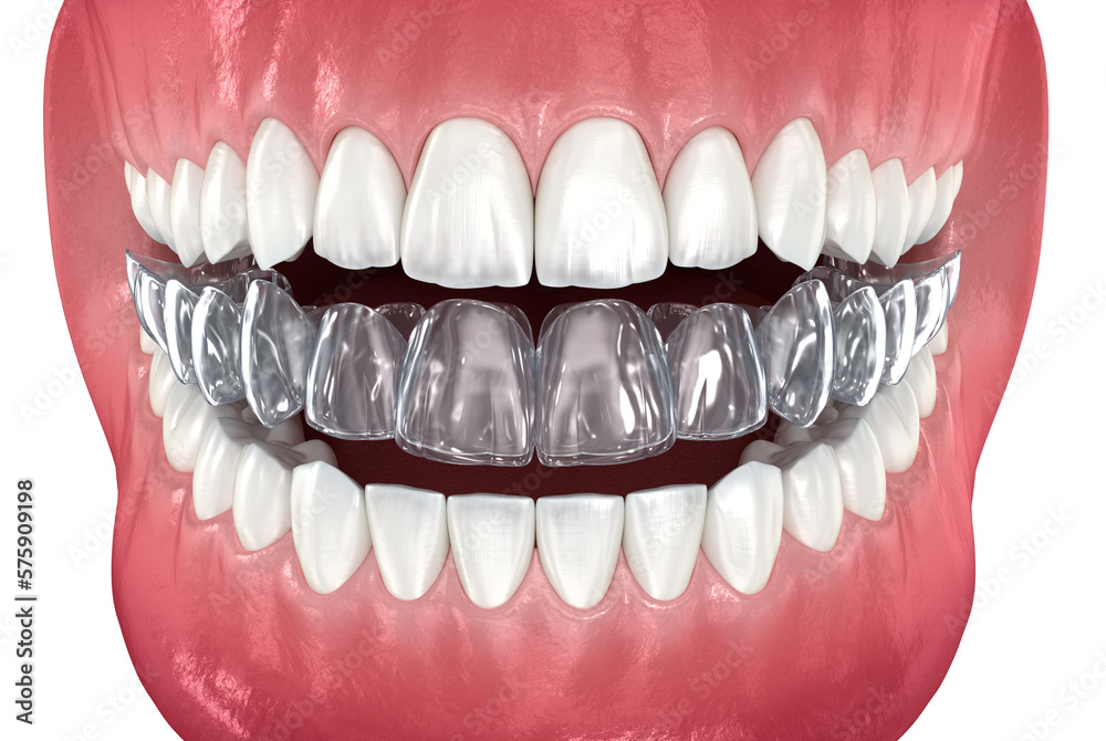 Obraz premium Invisalign braces or invisible retainer. Medically accurate dental 3D illustration