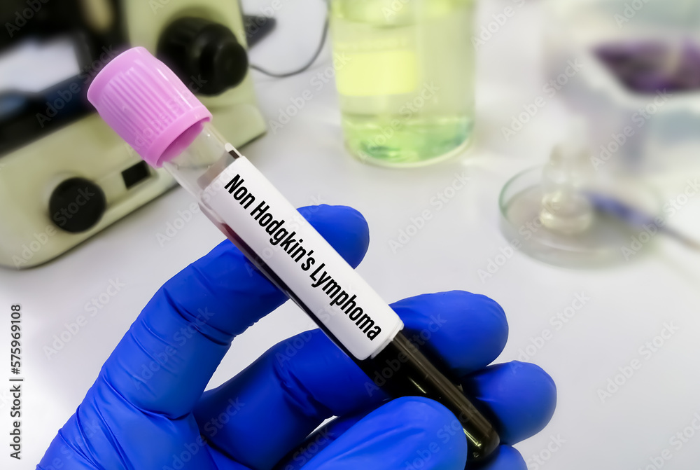 Scientist hold blood sample for NonHodgkin lymphoma (NHL) test. Non