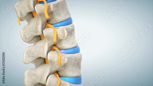 Spine demonstrating herniated disc, pressure nerve root causing back pain  photo