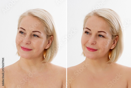 Closeup before after Beauty middle age woman face portrait. Before-after Spa anti wrinkled aging female body parts concept. Mid-aged Plastic surgery collagen face injections. Beauty Wrinkles menopause