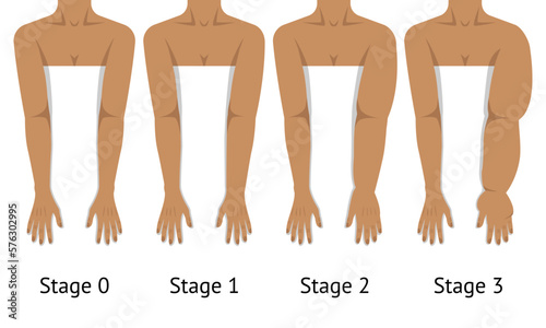 Women's arms in different stages of Lymphedema photo