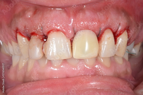 Dentistry patient with esthetical condition, bad composite restoration in the central incisor, prosthodontic crown after surgical act and suture thread with bloody gingival gum.