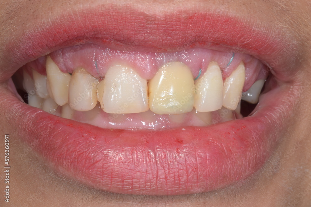 Fototapeta premium Frontal view of a woman mouth smiling with fake teeth of porcelain fixed prosthetic dental crown in central incisor and gingiva surgery and surgical suture thread.