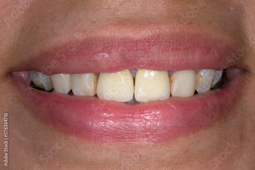 Frontal view of a woman mouth smiling with fake teeth fixed prosthetic dental crowns in central incisors.