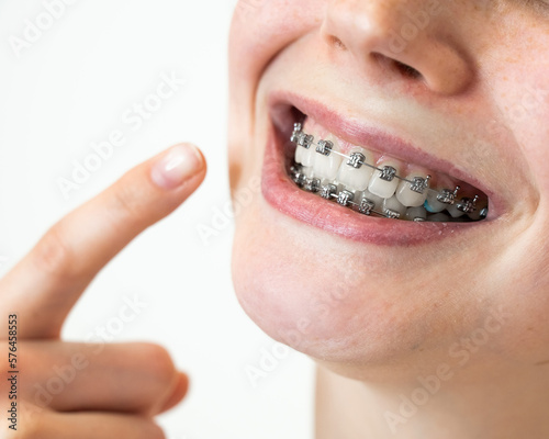 Close-up portrait of a young woman pointing at a smile with braces on her teeth.