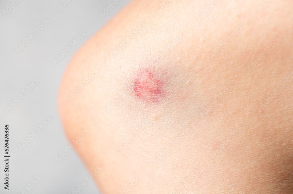 big bruise on the girl's skin close up. Skin hematoma. Purple wound. Skin injury. Skin trauma. big bruise on the girl's skin close up. Skin hematoma. Purple wound. Skin injury. Skin trauma.