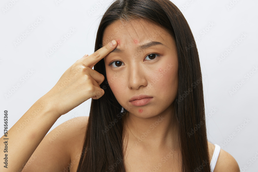 Asian woman facial skin problems, acne and inflammation, red rashes and allergies, chicken pox, sadness from rashes. Facial skin care concept for diseases and nerves Asian woman facial skin problems, acne and inflammation, red rashes and allergies, chicken pox, sadness from rashes. Facial skin care concept for diseases and nerves