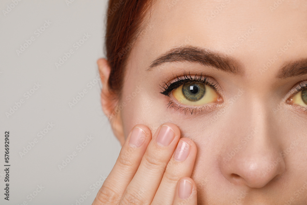 Woman with yellow eyes on light grey background, closeup. Symptom of hepatitis - obrazy, fototapety, plakaty 
