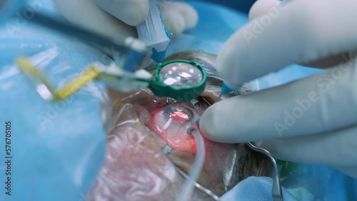 Eye surgery, vitreoretinal. Vitrectomy surgery. photo