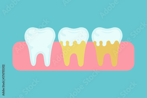 Dental plaque. Yellow teeth. Damaged enamel. Neglected teeth. Dirty teeth. Vector