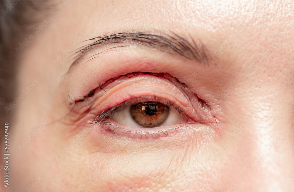 Obraz premium Plastic surgery of the face, skin tightening around the eyes. Surgical procedure to strengthen the skin of the eyelids, remove fatty hernias in the eyes. Operational blepharoplasty.