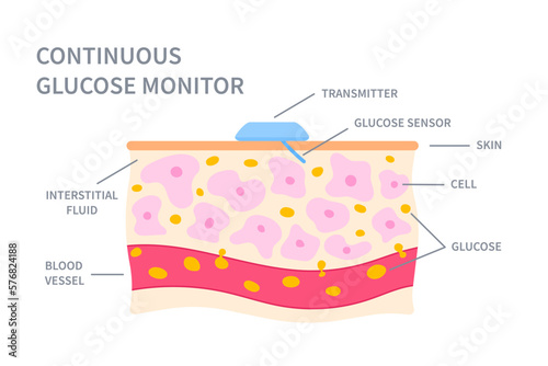 Continuous glucose sugar monitor. Glucometer wireless transmeter. CGM device on patient's skin. Measurement of blood glucose level. Vector illustration.
