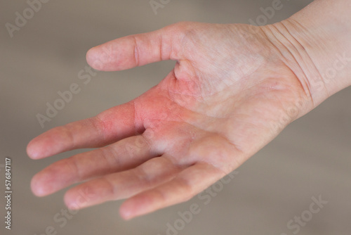 Dermatitis on skin. Human hand. Dermatological disease. The symptom is itching, pain, redness and rash. Allergic reaction. Medical diagnostics and treatment. Photo closeup