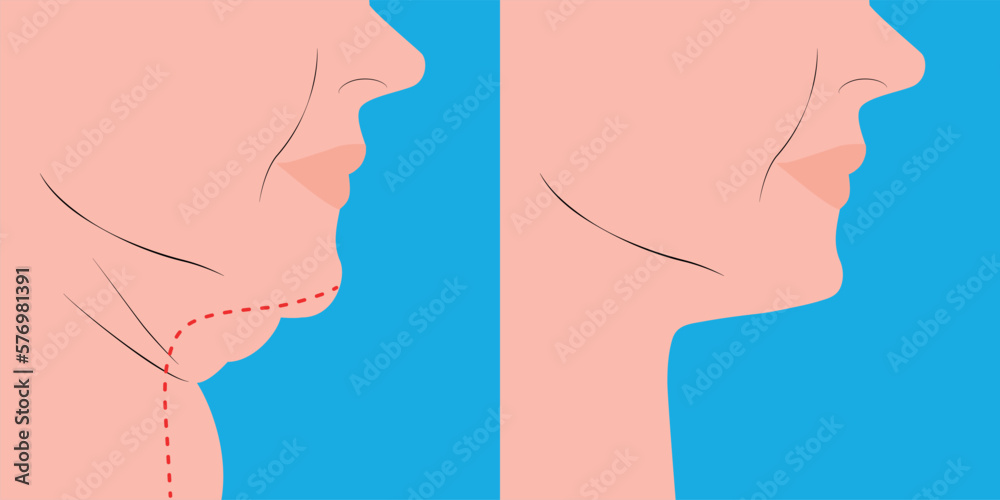Fat double chin reducing, facelift before and after Stock Vector Adobe Stock