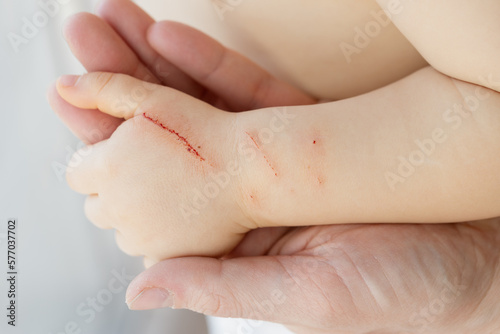 Severe wound on the child's hand. The animal bit and scratched a small child by the hand