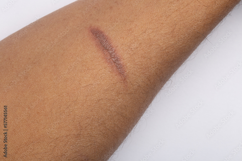 Minor Burn on Arm - Not Dangerous Minor Burn on Arm - Not Dangerous