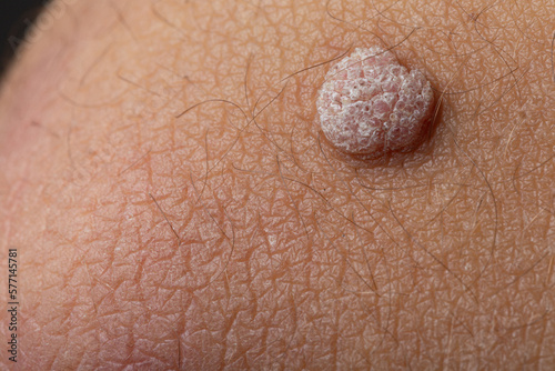 close up of skin, Zoomed-in Shot of Wart on Arm photo